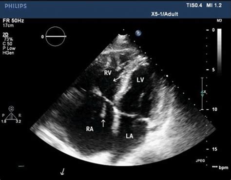 2d Transthoracic Echocardiography Tte Four Chamber View During The