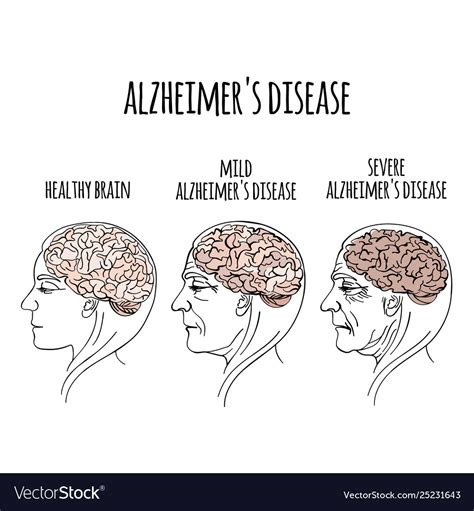Dementia Alzheimer Disease Medicine Royalty Free Vector