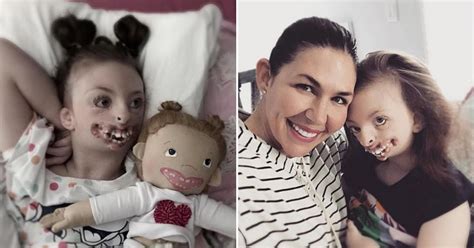 Girl With Facial Deformities And Rare Brain Disorder Has Passed Away Aged Small Joys