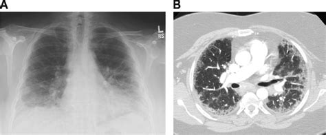 Representative Chest X Ray A And Ct Scan B Of Chronic Eosinophilic