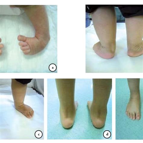 Kaplanmeier Curve For Repeat Surgery For Clubfoot Time Mo Children