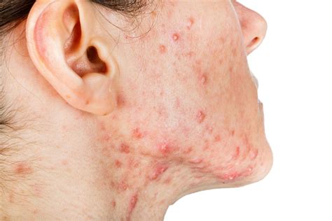 “mt Everest” A Case Of Cystic Acne Cystic Acne Skin Conditions Acne