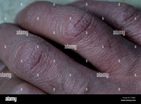 Fingers Close Up With Dry Skin Cracked White Dry Skin Damaged By