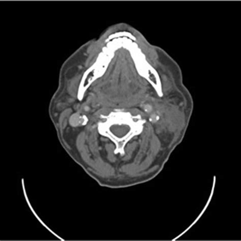 Computed Tomography Scan Of The Neck With Contrast Post Treatment