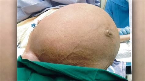 Doctors Remove Massive 28kg Tumour From Womans Uterus