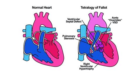 What Is Tetralogy Of Fallot