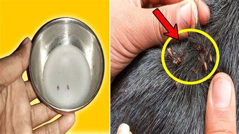 How To Remove Lice Egg And Nits Permanently From Your Hairs Naturally