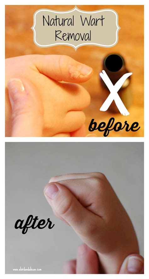 Natural Effective Wart Removal