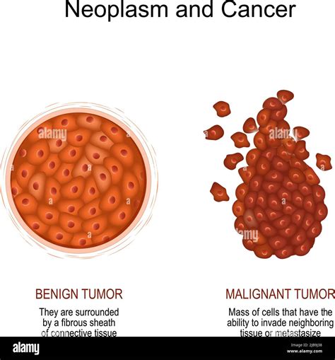 Neoplasia Y Cáncer Comparación Y Diferencia De Un Tumor Maligno Y