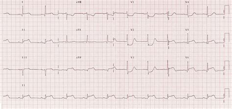 Lateral Stemi Ecg Changes Litfl Ecg Library Diagnosis