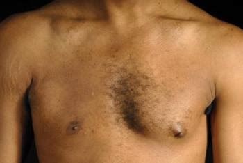 For unknown reasons, this disorder occurs more than twice as often in males than in females. Muscle Defects - Children's Health Issues - Merck Manuals ...