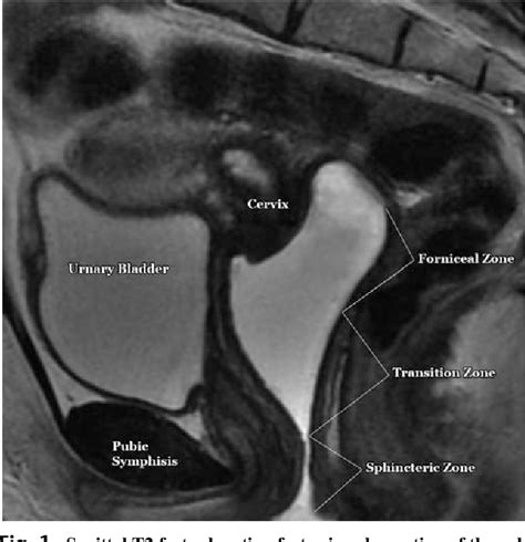 Figure From Vaginal Anatomy On Mri New Information Obtained Using