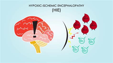 Hypoxic Ischemic Encephalopathy About Treatments And Causes Youtube