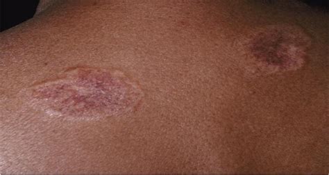 Cutaneous Manifestations Of Sarcoidosis Journal Of The Dermatology