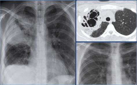 The Radiology Assistant Chest X Ray Lung Disease