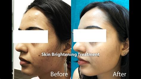 Amazing Before And After Results At Skinqure Best Skin Clinic In