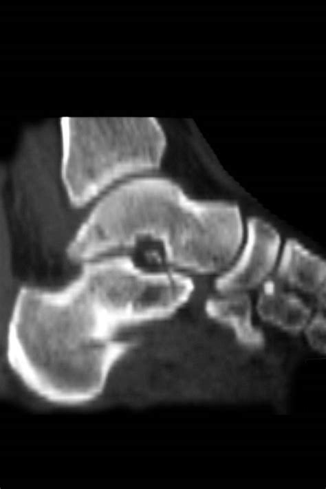 Fracture Of The Posterior Process Of Talus With Pilon Fracture A Case