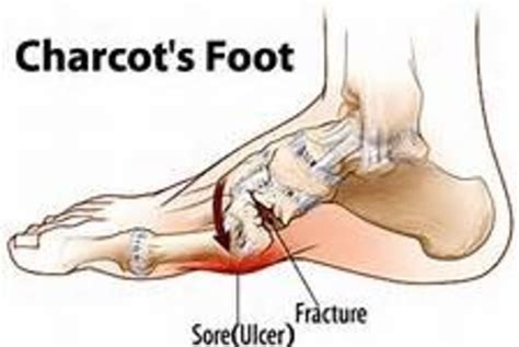 Diabetes And Charcot Foot A Dangerous Condition Which Needs Careful Control Hubpages