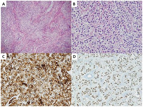 Clear Cell Myoepithelial Carcinoma In The Base Of The Tongue Case