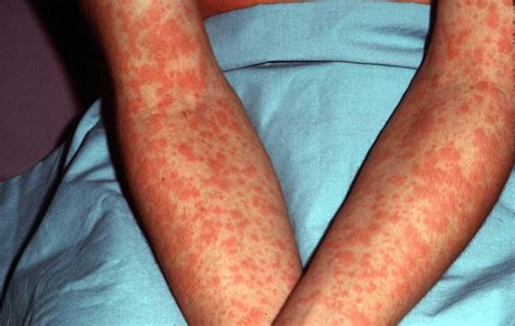 Mononucleosis Causes Symptoms Diagnosis Test And Treatment
