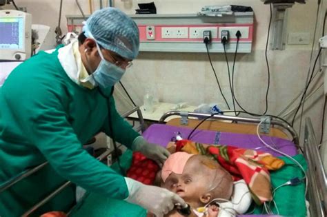 Baby With Worlds Biggest Head Stuns Medics In India As