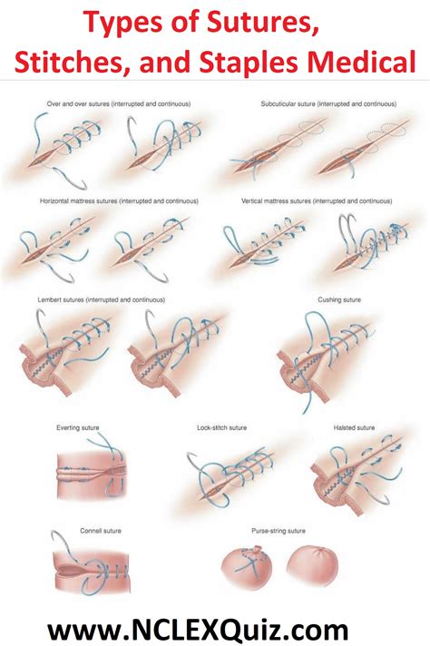 Types Of Sutures Stitches And Staples Medical Nclex Quiz