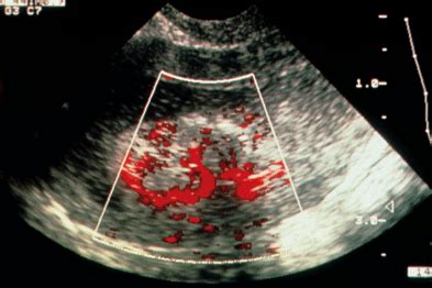 Maybe you would like to learn more about one of these? Understanding pelvic ultrasound reports | GPonline