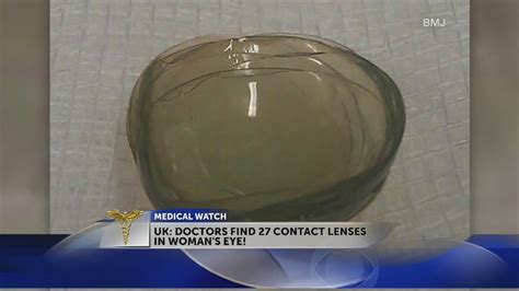Surgeon Finds 27 Contact Lenses In Womans Eye Youtube
