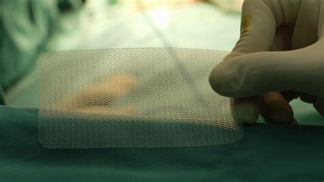 Complications With Hernia Mesh Defective Medical Device Lawyers
