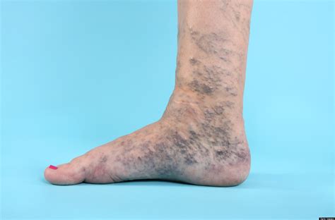 A Nice Result For Patients Varicose Veins And Leg Ulcers