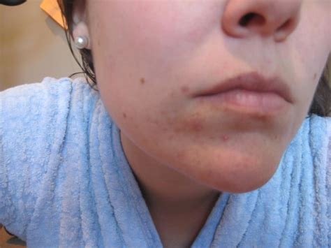 Lots Of Indented Scars Forming All At Once Scar Treatments Acne
