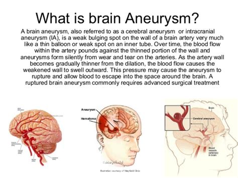 How To Detect A Brain Aneurysm Brainlyxg