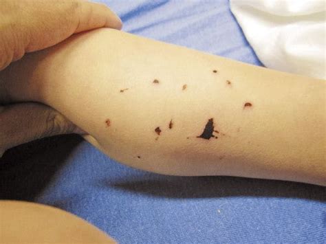 Black Spots On A Toddlers Skin