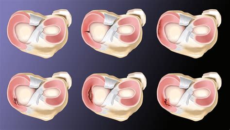 We did not find results for: Meniscus Injuries - ACE Physical Therapy and Sports ...