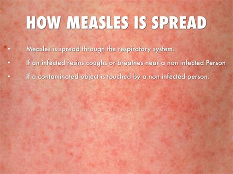 Measles By Anna Baricevic
