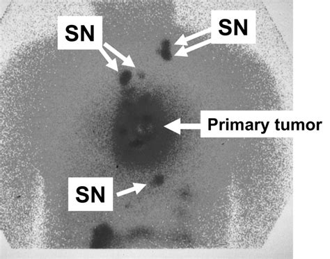 Preoperative Lymphoscintigraphy In Thoracic Esophageal Cancer Sn