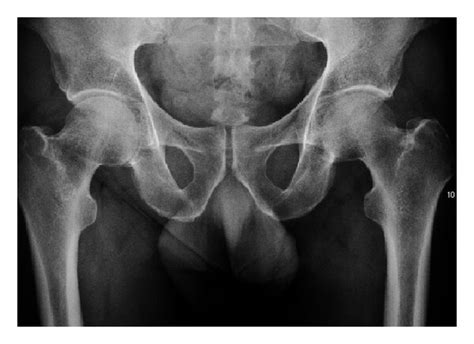 A X Ray Of A Patient With Transient Osteoporosis Of The Left Hip
