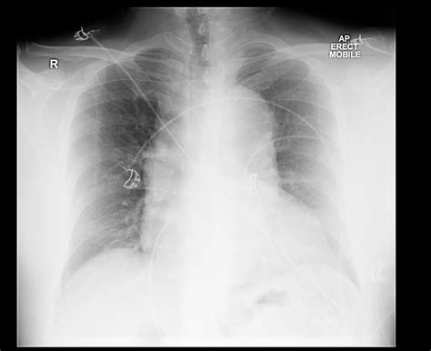 Dissection Chest X Ray