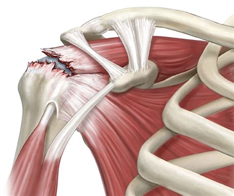 Rotator Cuff Repair Surgical Rehab Specialists