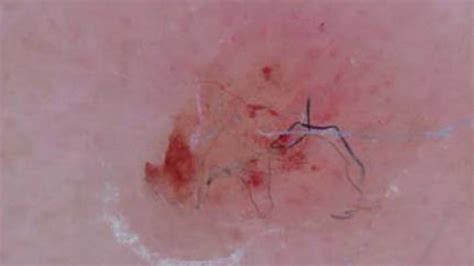Morgellons Causes Picture Symptoms And Treatment