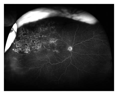 Ultra Wide Field Fluorescein Angiogram Of An Eye With A Superotemporal