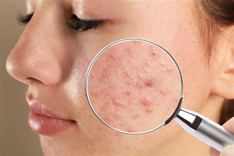 Teenage Girl With Acne Problem Visiting Dermatologist Skin Under