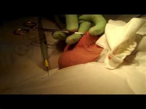 It's a very unpleasant feeling constantly. VASECTOMIE - VIDEO RESUME - TECHNIQUE SANS AIGUILLE SANS ...