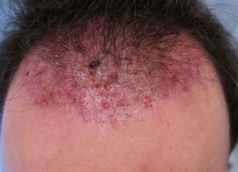 Ingrown Hair On Scalp Head Cyst Pictures Causes Symptoms And How To