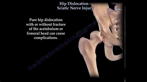 Hip Dislocation Sciatic Nerve Injury Everything You Need To Know