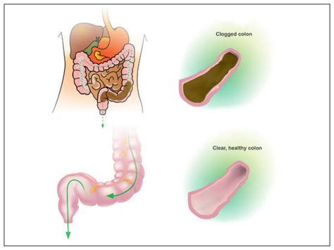 No apparent difference in the incidence of. How Being Overweight Cause Colon Cancer Risk - Boldsky.com