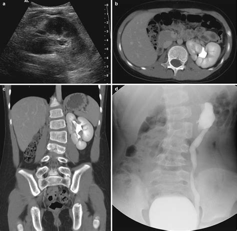 Congenital Anomalies Of The Upper Urinary Tract Radiology Key