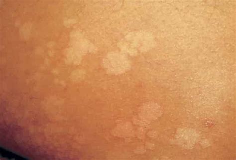 Health Feed Tinea Versicolor Causes Symptoms And Treatment