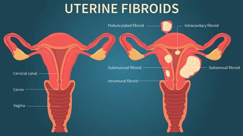 The Link Between Uterine Fibroids And Heavy Menstrual Bleeding