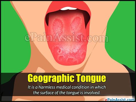 Geographic Tongue Geographic Tongue Healthy Tongue Glossitis
